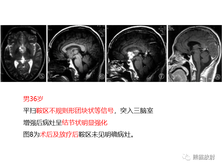 影像PPT - 【病例】颅内生殖细胞瘤2例MR-29