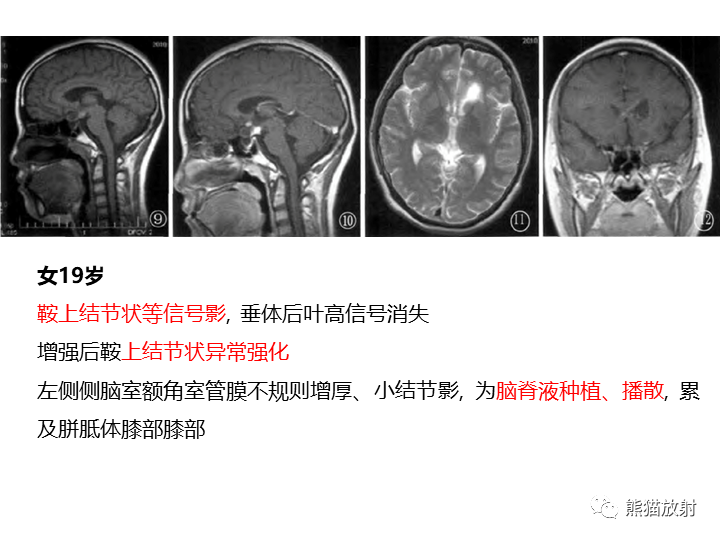 影像PPT - 【病例】颅内生殖细胞瘤2例MR-30