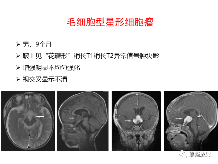影像PPT - 【病例】颅内生殖细胞瘤2例MR-35