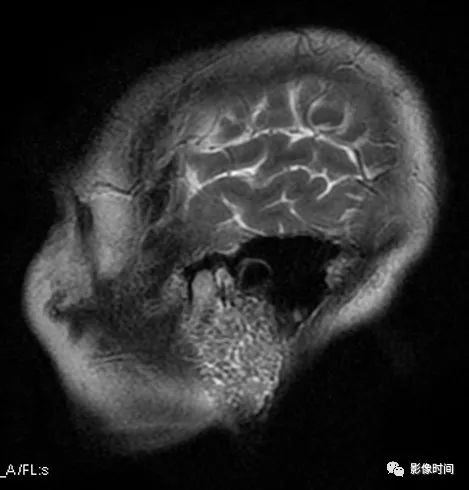 影像PPT - 【病例】舍格伦综合征—干燥综合征SS一例MR影像诊断-5 影像PPT - 【病例】舍格伦综合征—干燥综合征SS一例MR影像诊断-5
