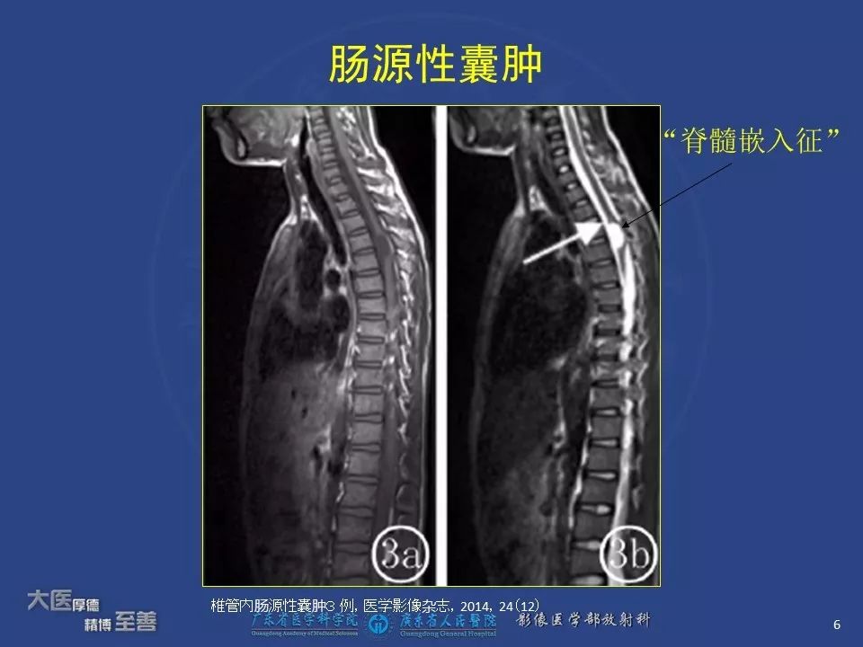 影像PPT - 【PPT】颅内神经肠源性囊肿-4