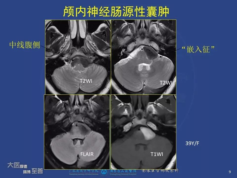 影像PPT - 【PPT】颅内神经肠源性囊肿-7