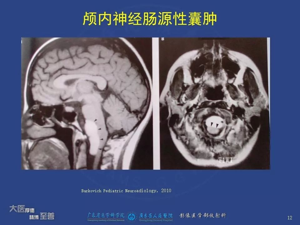 影像PPT - 【PPT】颅内神经肠源性囊肿-10