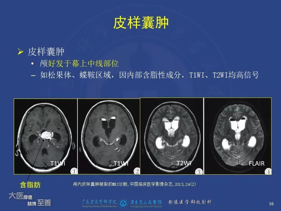 影像PPT - 【PPT】颅内神经肠源性囊肿-14