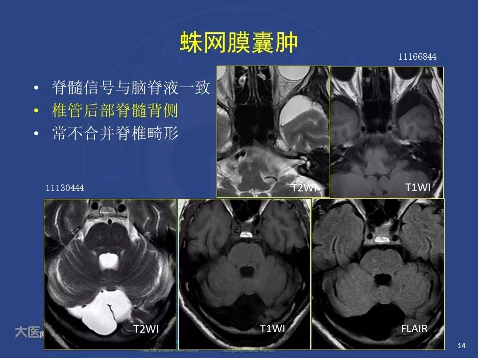 影像PPT - 【PPT】颅内神经肠源性囊肿-12