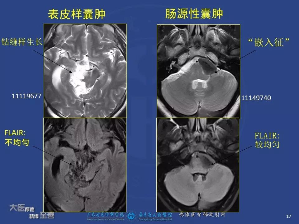 影像PPT - 【PPT】颅内神经肠源性囊肿-15