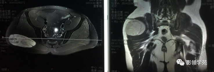 影像PPT - 四肢脂肪肉瘤影像学表现-4 影像PPT - 四肢脂肪肉瘤影像学表现-4