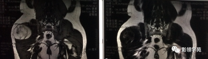 影像PPT - 四肢脂肪肉瘤影像学表现-5 影像PPT - 四肢脂肪肉瘤影像学表现-5