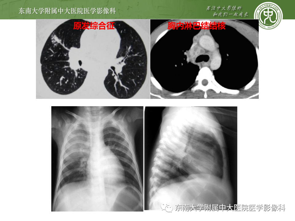 影像PPT - 【PPT】肺结核影像表现及鉴别-6