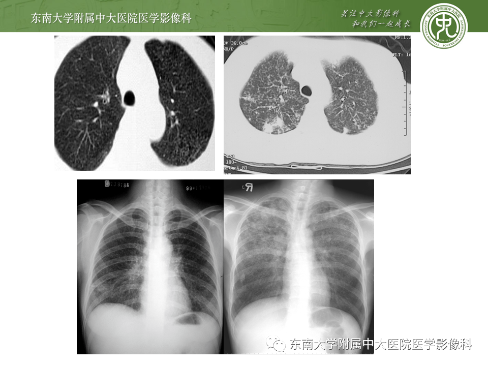 影像PPT - 【PPT】肺结核影像表现及鉴别-8