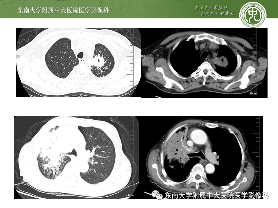 影像PPT - 【PPT】肺结核影像表现及鉴别-11