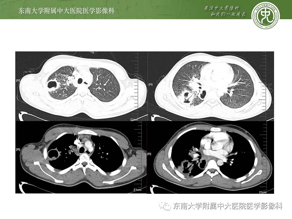 影像PPT - 【PPT】肺结核影像表现及鉴别-13