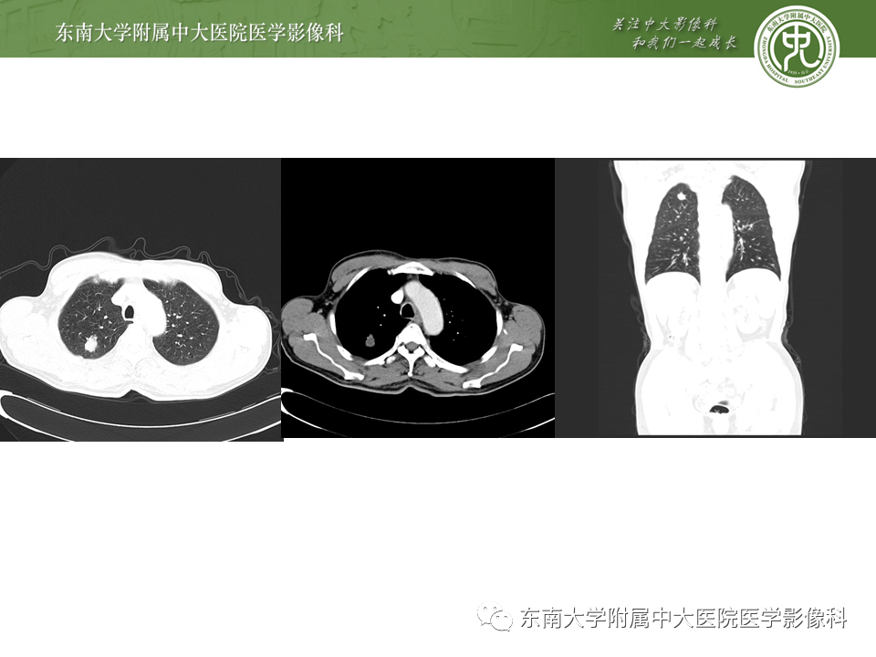 影像PPT - 【PPT】肺结核影像表现及鉴别-15