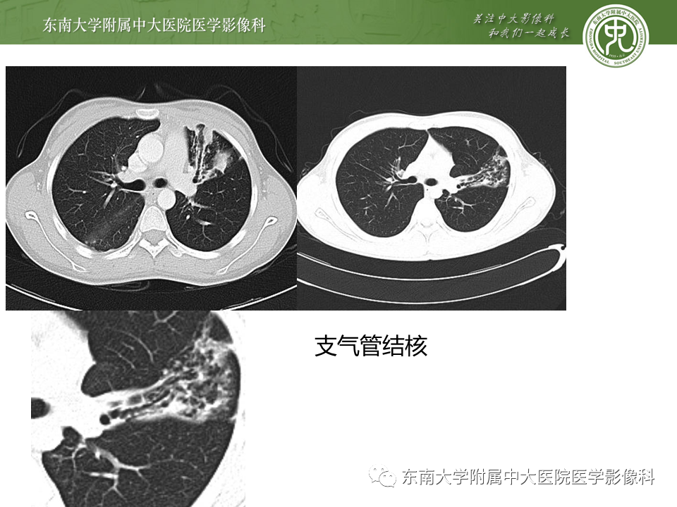 影像PPT - 【PPT】肺结核影像表现及鉴别-17