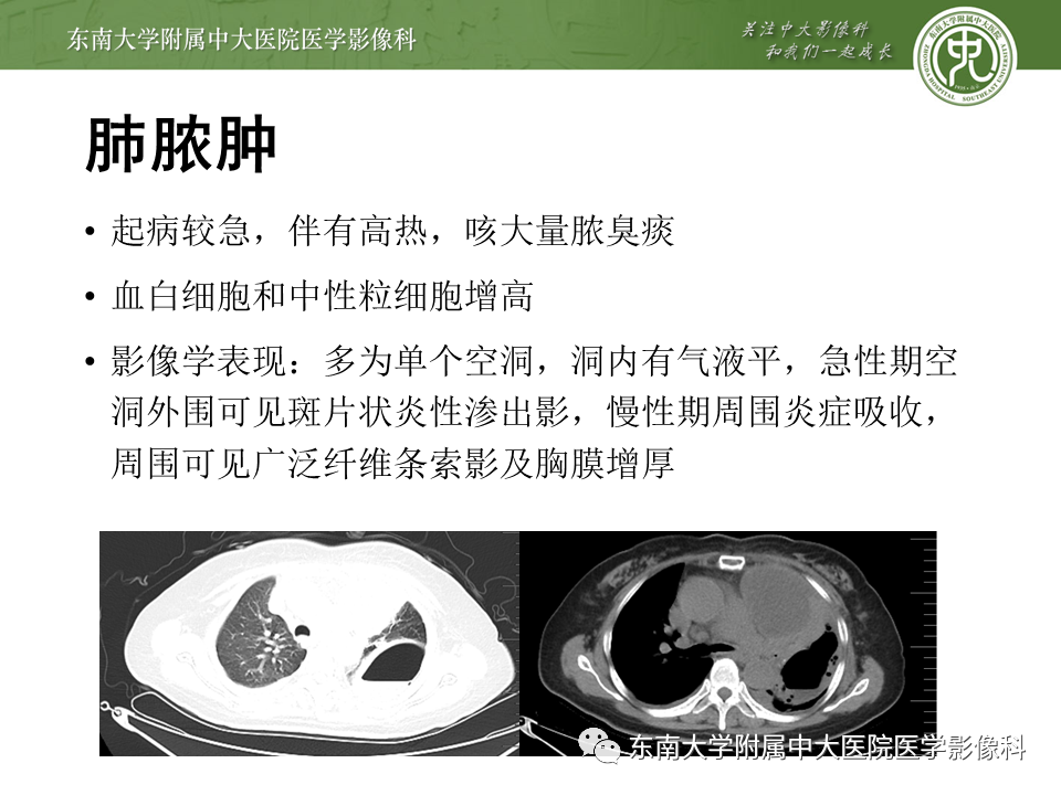 影像PPT - 【PPT】肺结核影像表现及鉴别-20