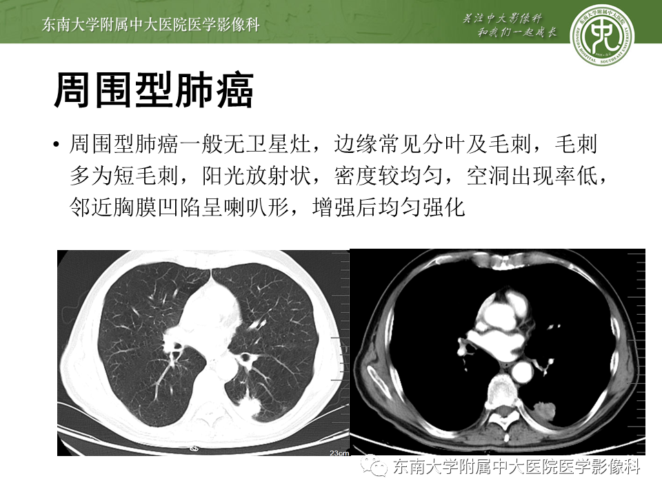 影像PPT - 【PPT】肺结核影像表现及鉴别-19