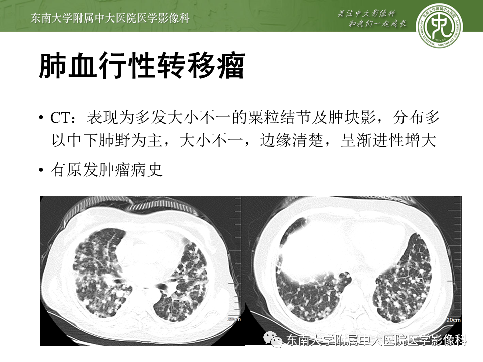 影像PPT - 【PPT】肺结核影像表现及鉴别-21