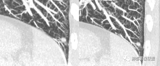影像PPT - 【病例】一例肺纤毛黏液结节性乳头状瘤CT并文献复习-11 影像PPT - 【病例】一例肺纤毛黏液结节性乳头状瘤CT并文献复习-11