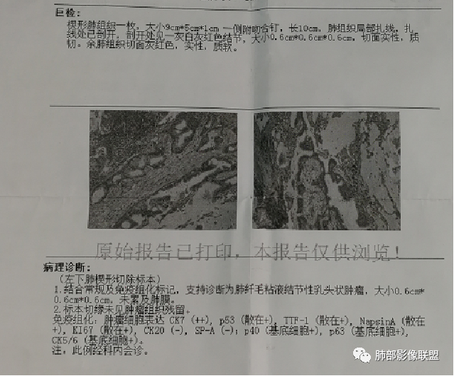 影像PPT - 【病例】一例肺纤毛黏液结节性乳头状瘤CT并文献复习-13 影像PPT - 【病例】一例肺纤毛黏液结节性乳头状瘤CT并文献复习-13