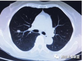 影像PPT - 【病例】一例肺纤毛黏液结节性乳头状瘤CT并文献复习-16 影像PPT - 【病例】一例肺纤毛黏液结节性乳头状瘤CT并文献复习-16