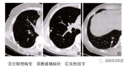 影像PPT - 【病例】一例肺纤毛黏液结节性乳头状瘤CT并文献复习-22 影像PPT - 【病例】一例肺纤毛黏液结节性乳头状瘤CT并文献复习-22