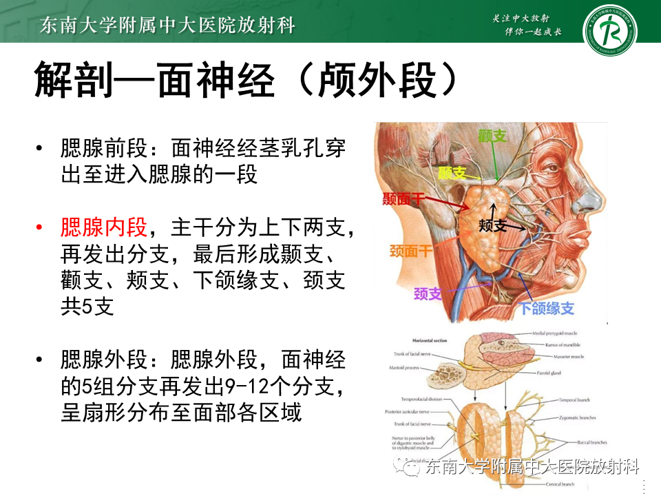 影像PPT - 【PPT】腮腺腺淋巴瘤的影像-6 影像PPT - 【PPT】腮腺腺淋巴瘤的影像-6