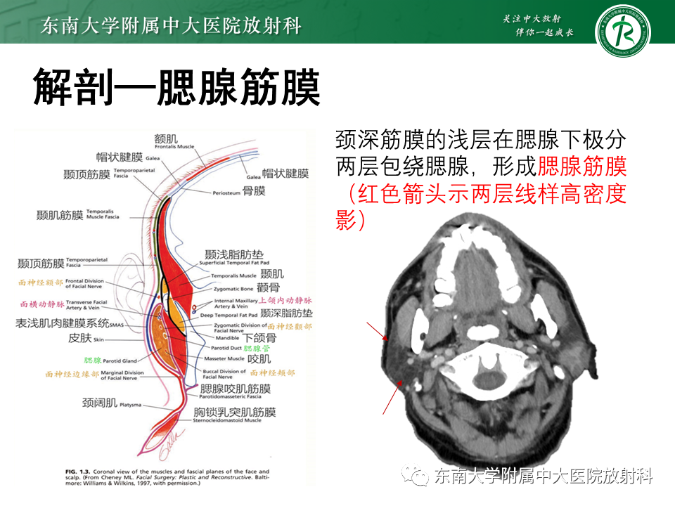 影像PPT - 【PPT】腮腺腺淋巴瘤的影像-8 影像PPT - 【PPT】腮腺腺淋巴瘤的影像-8