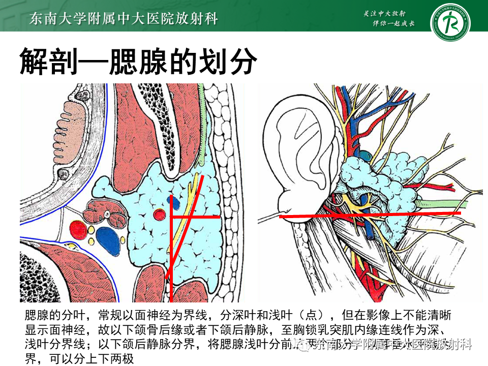 影像PPT - 【PPT】腮腺腺淋巴瘤的影像-9 影像PPT - 【PPT】腮腺腺淋巴瘤的影像-9