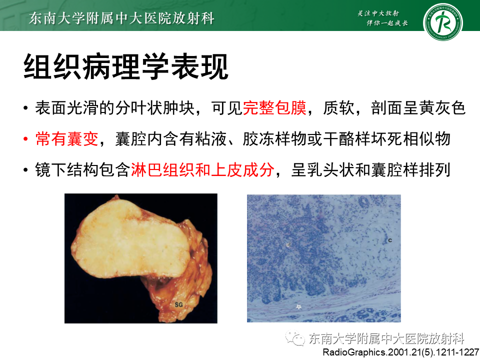 影像PPT - 【PPT】腮腺腺淋巴瘤的影像-13 影像PPT - 【PPT】腮腺腺淋巴瘤的影像-13