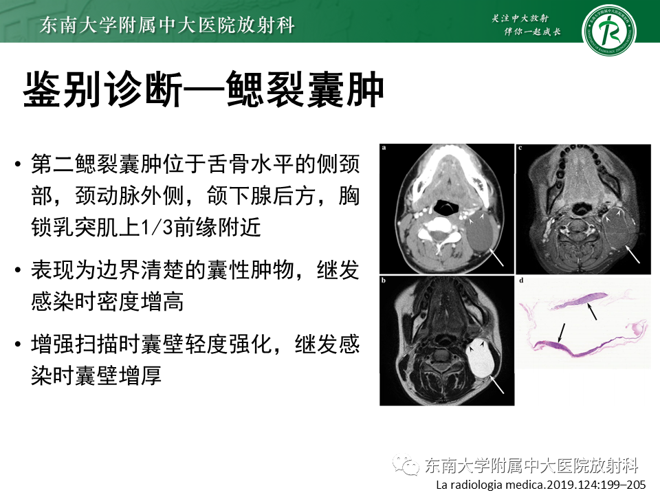 影像PPT - 【PPT】腮腺腺淋巴瘤的影像-18 影像PPT - 【PPT】腮腺腺淋巴瘤的影像-18