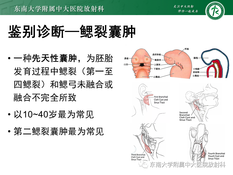 影像PPT - 【PPT】腮腺腺淋巴瘤的影像-17 影像PPT - 【PPT】腮腺腺淋巴瘤的影像-17