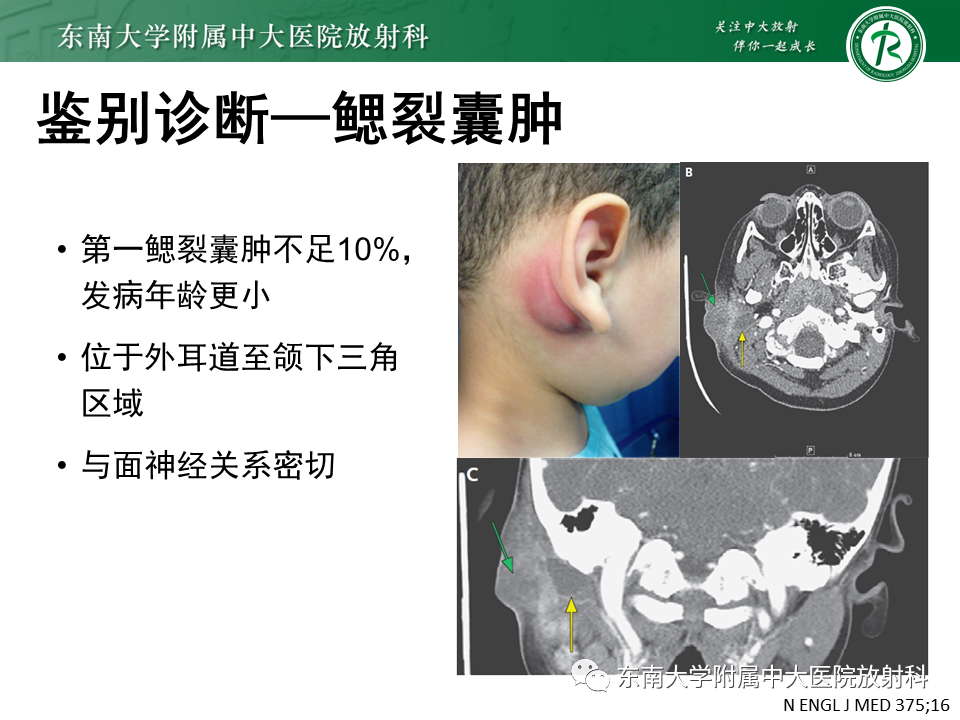 影像PPT - 【PPT】腮腺腺淋巴瘤的影像-19 影像PPT - 【PPT】腮腺腺淋巴瘤的影像-19