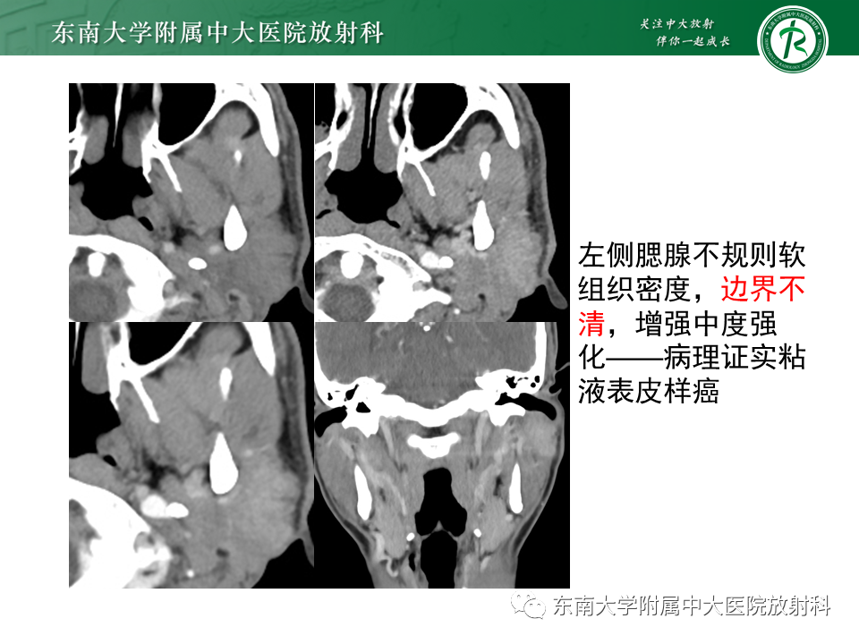 影像PPT - 【PPT】腮腺腺淋巴瘤的影像-23 影像PPT - 【PPT】腮腺腺淋巴瘤的影像-23