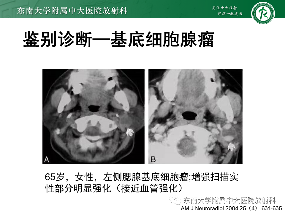影像PPT - 【PPT】腮腺腺淋巴瘤的影像-21 影像PPT - 【PPT】腮腺腺淋巴瘤的影像-21