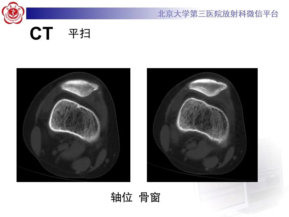 影像PPT - 【PPT】髌骨脱位的影像-2