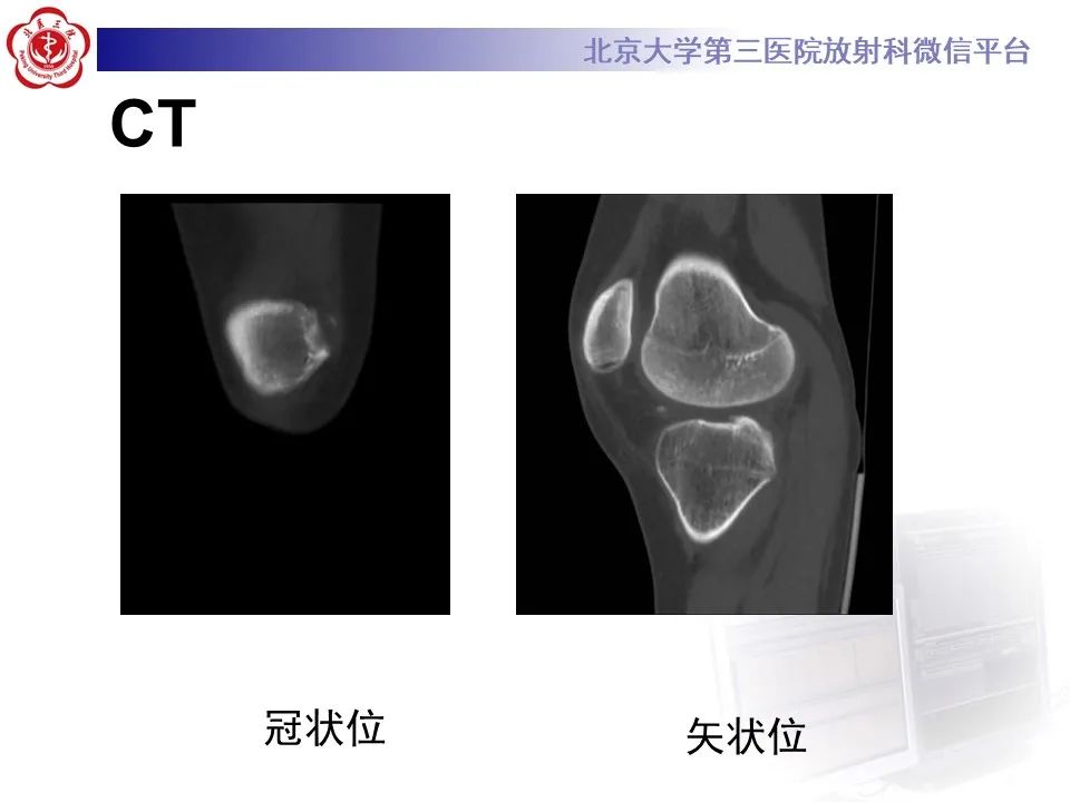 影像PPT - 【PPT】髌骨脱位的影像-3