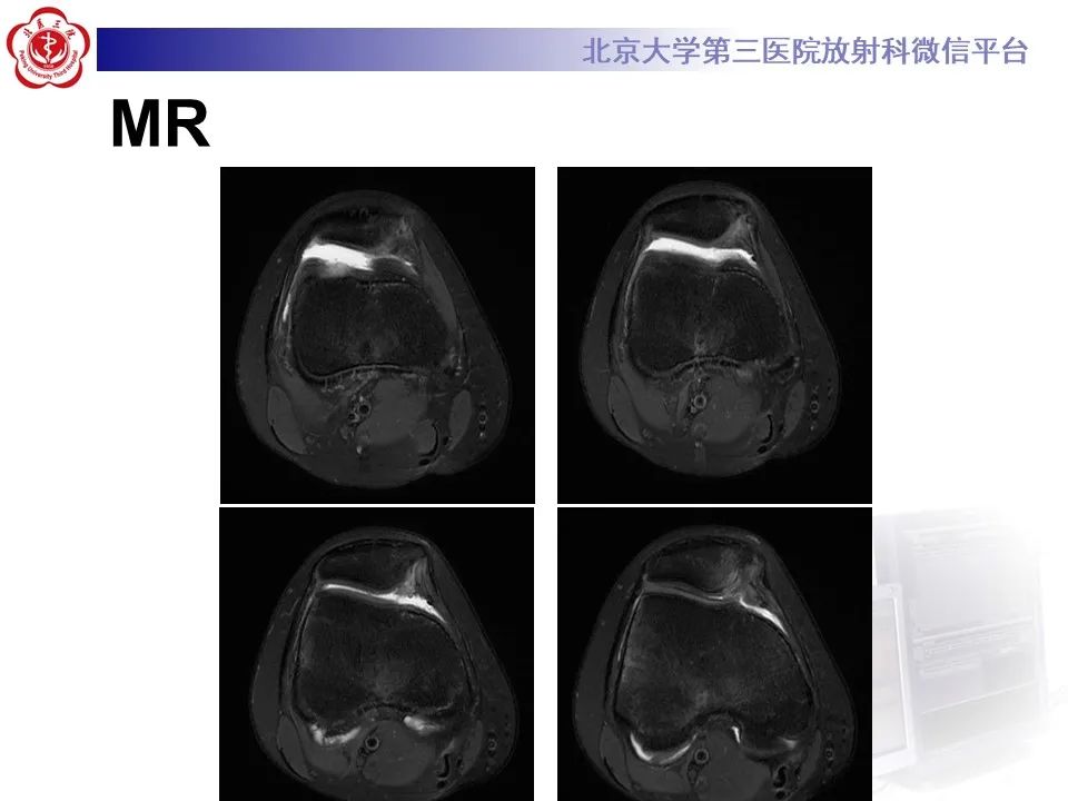 影像PPT - 【PPT】髌骨脱位的影像-4