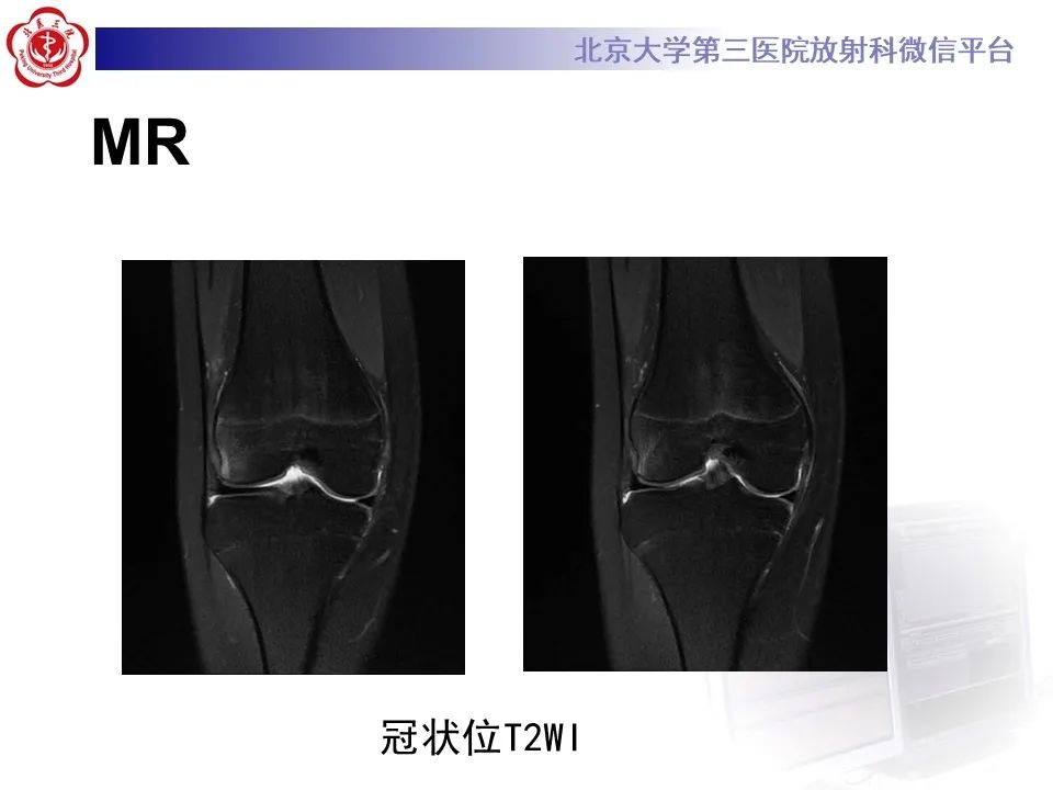 影像PPT - 【PPT】髌骨脱位的影像-5
