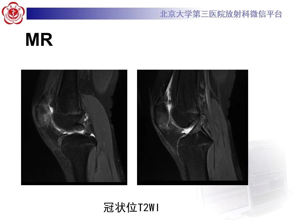 影像PPT - 【PPT】髌骨脱位的影像-6