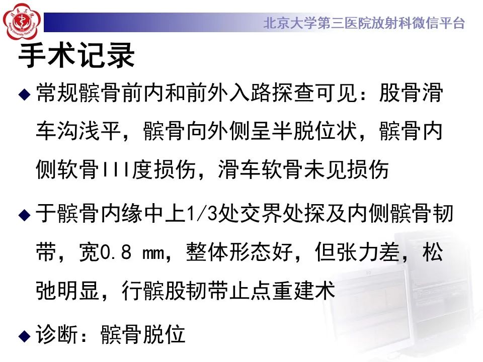 影像PPT - 【PPT】髌骨脱位的影像-9