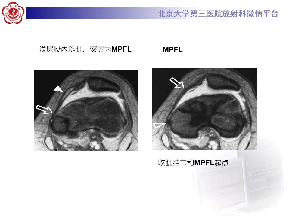 影像PPT - 【PPT】髌骨脱位的影像-14