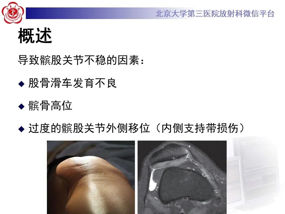 影像PPT - 【PPT】髌骨脱位的影像-12
