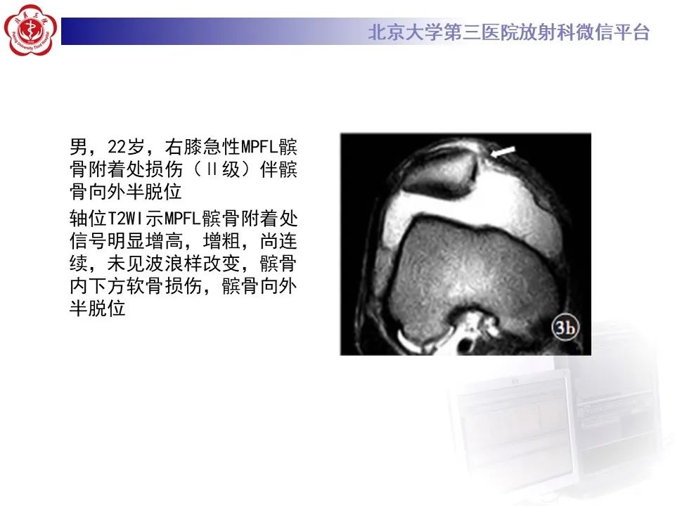 影像PPT - 【PPT】髌骨脱位的影像-18