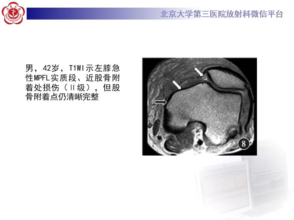 影像PPT - 【PPT】髌骨脱位的影像-19