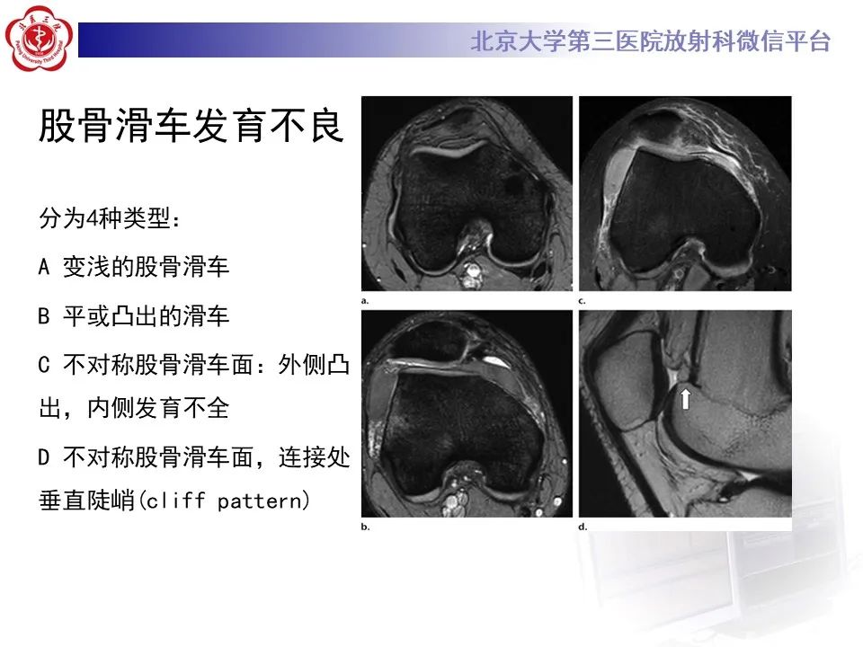 影像PPT - 【PPT】髌骨脱位的影像-20