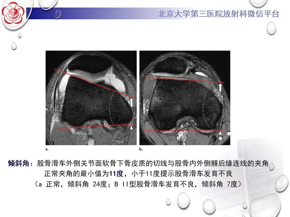 影像PPT - 【PPT】髌骨脱位的影像-21