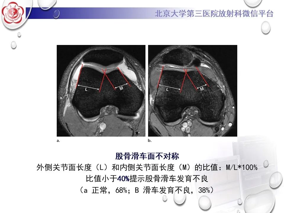 影像PPT - 【PPT】髌骨脱位的影像-22