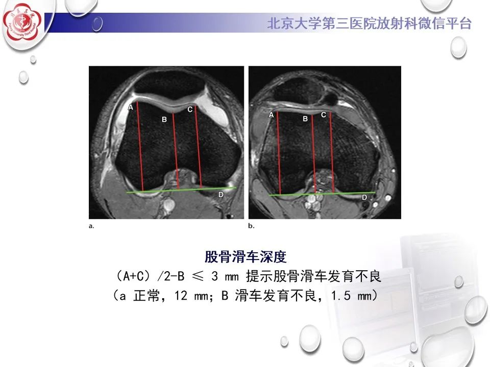 影像PPT - 【PPT】髌骨脱位的影像-23