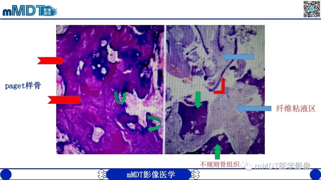 影像PPT - 【PPT】浅谈脂肪硬化性粘液纤维瘤(LSMFT)-5 影像PPT - 【PPT】浅谈脂肪硬化性粘液纤维瘤(LSMFT)-5