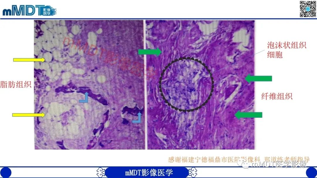 影像PPT - 【PPT】浅谈脂肪硬化性粘液纤维瘤(LSMFT)-4 影像PPT - 【PPT】浅谈脂肪硬化性粘液纤维瘤(LSMFT)-4